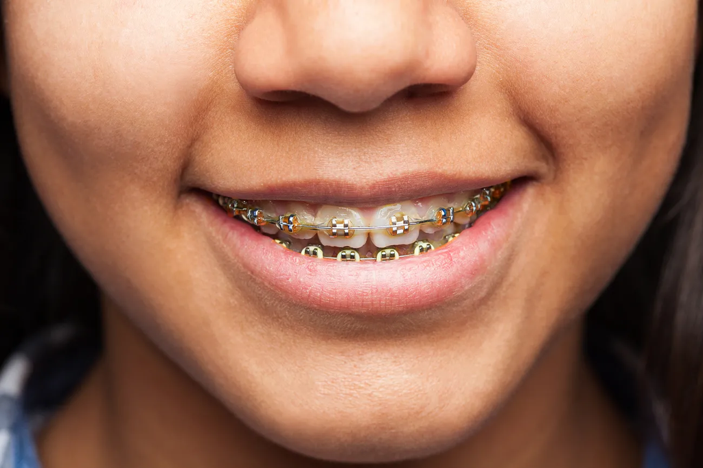 brasssmile